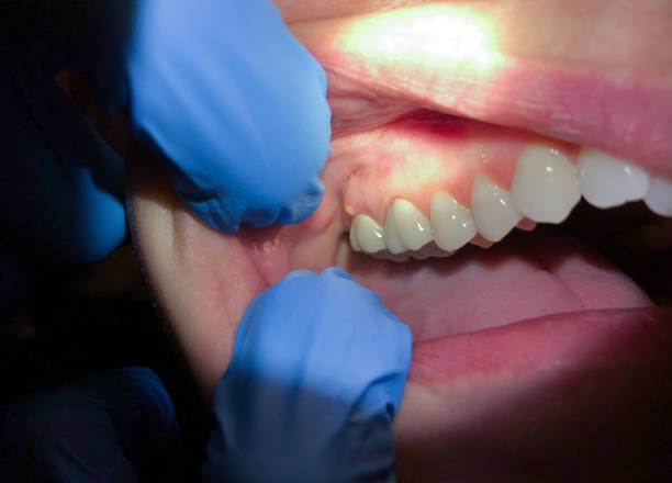 Best Emergency Wisdom Teeth Removal in Eton, GA